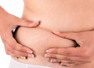 Cum scăpăm de vergeturi simplu şi eficient - www.elacraciun.ro