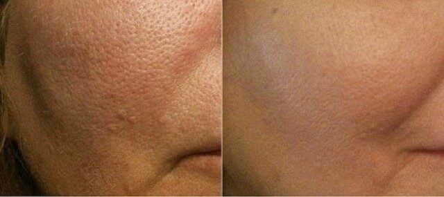 skin-pores-treatment-2924816