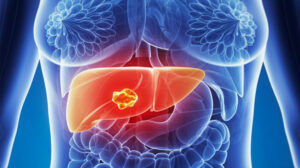 5 dintre alimentele care îți curăță ficatul